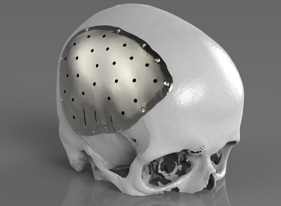 Renishaw demonstrates bespoke additively manufactured implants at 3D Printing in Medicine Conference