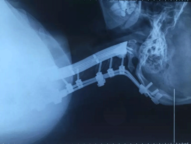 Chinese surgeons replace cervical vertebrae with additively manufactured titanium