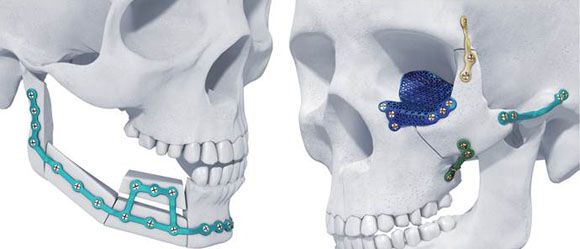 Materialise receives first US clearance for metal 3D printed maxillofacial implants