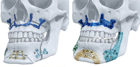 Materialise receives first US clearance for metal AM maxillofacial implants