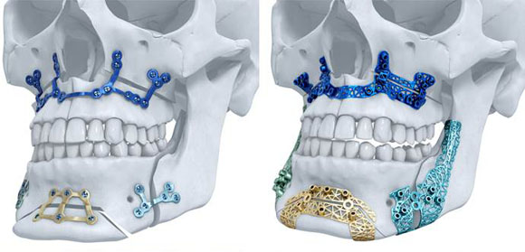 Materialise receives first US clearance for metal AM maxillofacial implants Materialise receives first US clearance for metal AM maxillofacial implants