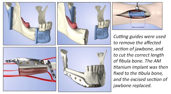 UK hospital completes jaw reconstruction using bone grafts with metal 3D printing