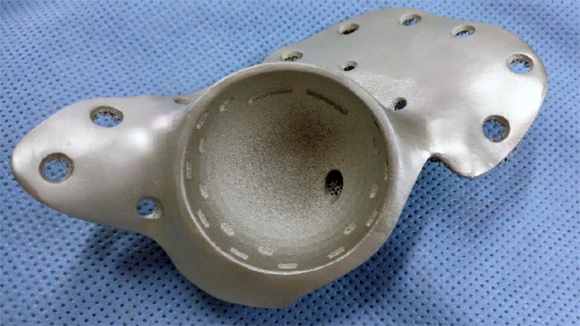 Link3D enables Argentinian orthopaedic implant maker’s first step into metal 3D printing