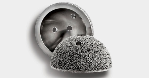 World’s first metal 3D printed hip implant turns ten 