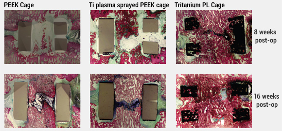 Stryker publishes pre-clinical study on bone in-growth potential of metal AM spinal cages