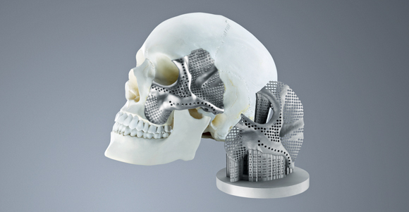 Russia's Conmet employs Trumpf technology for the production of custom craniomaxillofacial implants