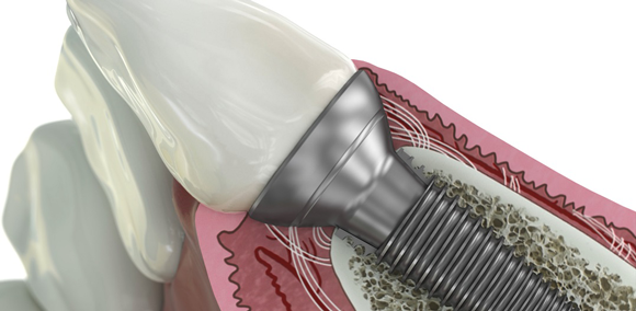 GE Additive technology enables new dental implant solution