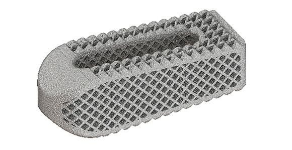 Osseus introduces additively manufactured titanium transforaminal lumbar interbody fusion device