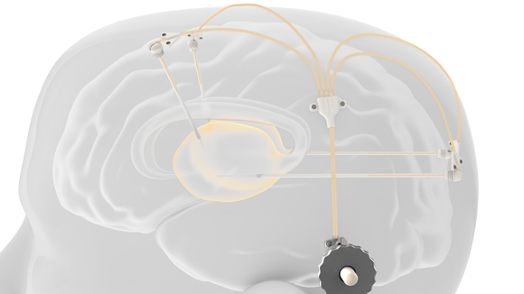 Clinical trial of Renishaw's Parkinson's drug delivery device nears completion