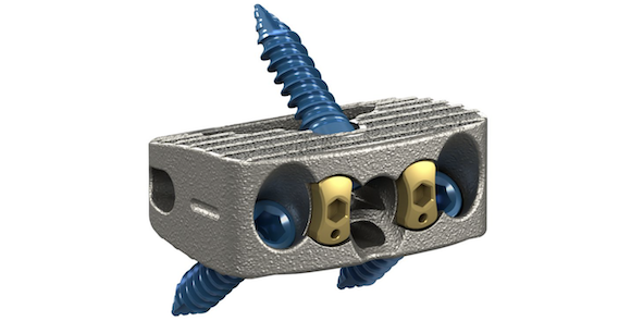 Stryker’s Monterey AL Interbody System utilises proprietary Tritanium (Ti mimicking cancellous bone) using the company’s 3D printing technique (Courtesy Stryker)