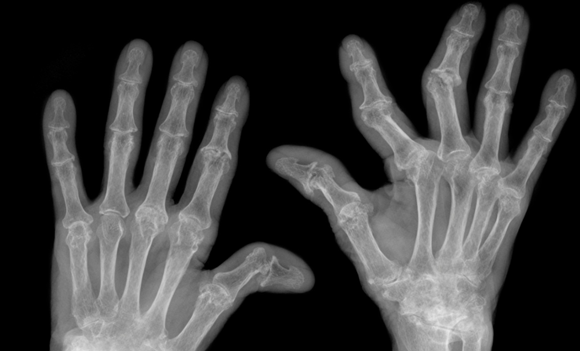 Even patients with severely bent fingers can receive optimal treatment with a FingerKIt implant (Courtesy Fraunhofer)