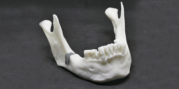 Mandibular model made of PLA with defect-fitting implant made of ZnMg, additively manufactured based on RWTH DAP’s newly developed design and alloy concept (Courtesy RWTH DAP)