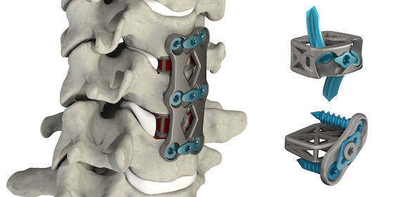 4WEB has announced the commercial launch of its Additively Manufactured Cervical Spine Plating Solution (CSTS-PS) (Courtesy 4WEB Medical)
