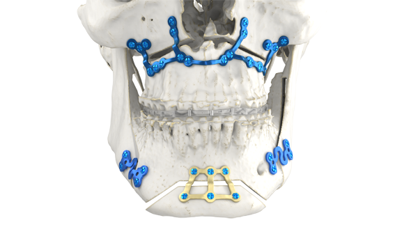 The new facility specialises in the Additive Manufacturing of personalised titanium cranio-maxillofacial (CMF) implants (Courtesy Materialise)