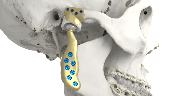 Materialise has launched its Personalised TMJ Total Arthroplasty System, a solution to treat patients requiring TMJ arthroplasty (Courtesy Materialise)