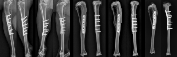 Fractures were fully united at week 12. At week 26, the fracture was fully united and a new bone remodelling occurred. Implants remain in-situ