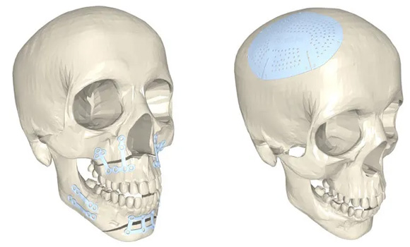 Orthognathic jaw alignment (left) featuring with custom AM plates designed using Polygonica directly on a mesh model from the patient's CT scan and (right) a craniomaxillofacial workflow to create a cranial implant skull cap to protect a damaged region of skull (Courtesy MachineWorks)