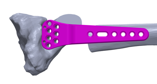 CAD of the titanium implant (Courtesy One Click Metal)