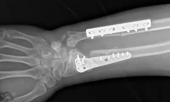 In-situ implants (Courtesy One Click Metal)