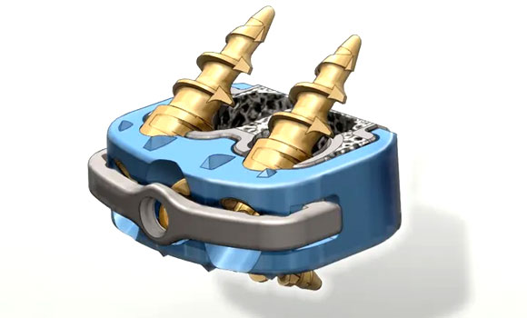 Lincotek’s SpineLinc Anterior Cervical Implant System has received 510k clearance (Courtesy Lincotek)