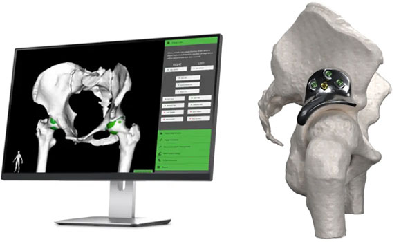 Replasia's portfolio complements Materialise’s existing personalised orthopaedic offering (Courtesy Materialise)