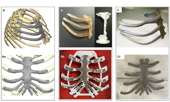 A,Aa – Virtual fit validation of the 3D implant. B, Bb – Physical fit validation C, Cc – The final additively manufactured titanium implant (Courtesy https://doi.org/10.1038/s44385-026-00113-6)