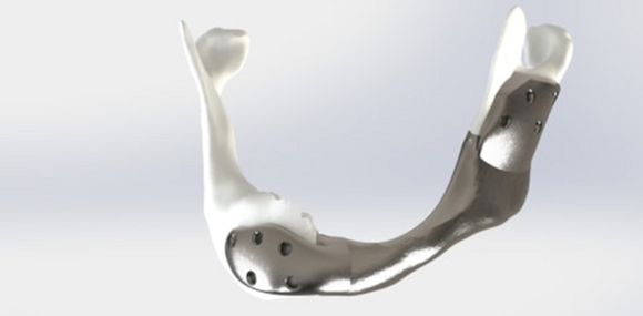 The Mobius 3D Technologies titanium jaw is bespoke based on patient MRI & CT scans (Courtesy the Antoni van Leeuwenhoek/Netherlands Cancer Institute)