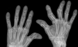 Even patients with severely bent fingers can receive optimal treatment with a FingerKIt implant (Courtesy Fraunhofer)