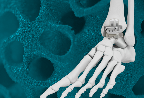 Restor3d launched foot and ankle products, including its total ankle replacement system (Courtesy Restor3d)